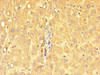 Immunohistochemistry of paraffin-embedded human liver cancer using CSB-PA890925LA01HU at dilution of 1:100