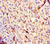 Immunohistochemistry of paraffin-embedded human melanoma using CSB-PA891566LA01HU at dilution of 1:100