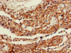 IHC image of CSB-PA891734HA01HU diluted at 1:600 and staining in paraffin-embedded human lung cancer performed on a Leica BondTM system. After dewaxing and hydration, antigen retrieval was mediated by high pressure in a citrate buffer (pH 6.0) . Section was blocked with 10% normal goat serum 30min at RT. Then primary antibody (1% BSA) was incubated at 4°C overnight. The primary is detected by a biotinylated secondary antibody and visualized using an HRP conjugated SP system.