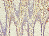 Immunohistochemistry of paraffin-embedded human colon cancer using CSB-PA891734LA01HU at dilution of 1:100