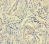 Immunohistochemistry of paraffin-embedded human pancreatic cancer using CSB-PA892143HA01HU at dilution of 1:100