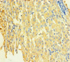 Immunohistochemistry of paraffin-embedded human liver cancer using CSB-PA892159LA01HU at dilution of 1:100