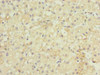 Immunohistochemistry of paraffin-embedded human liver cancer using CSB-PA892325LA01HU at dilution of 1:100