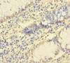 Immunohistochemistry of paraffin-embedded human colon cancer using CSB-PA892361LA01HU at dilution of 1:100