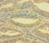 Immunohistochemistry of paraffin-embedded human endometrial cancer using CSB-PA892361LA01HU at dilution of 1:100