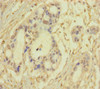 Immunohistochemistry of paraffin-embedded human pancreatic cancer using CSB-PA892486LA01HU at dilution of 1:100