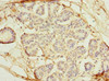 Immunohistochemistry of paraffin-embedded human breast cancer using CSB-PA897460LA01HU at dilution of 1:100
