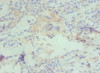 Immunohistochemistry of paraffin-embedded human breast cancer using CSB-PA004600ESR2HU at dilution of 1:100