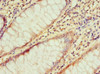 Immunohistochemistry of paraffin-embedded human colon cancer using CSB-PA011810ESR1HU at dilution of 1:100