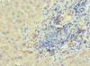 Immunohistochemistry of paraffin-embedded human liver cancer using CSB-PA011810ESR1HU at dilution of 1:100