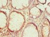 Immunohistochemistry of paraffin-embedded human colon cancer using CSB-PA010902ESR2HU at dilution of 1:100