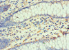 Immunohistochemistry of paraffin-embedded human colon cancer using CSB-PA006954ESR2HU at dilution of 1:100