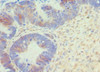 Immunohistochemistry of paraffin-embedded human ovarian cancer using CSB-PA002608ESR2HU at dilution of 1:100