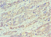 Immunohistochemistry of paraffin-embedded human endometrial cancer using CSB-PA002608ESR2HU at dilution of 1:100