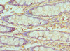 Immunohistochemistry of paraffin-embedded human colon cancer using CSB-PA025855ESR1HU at dilution of 1:100