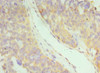 Immunohistochemistry of paraffin-embedded human endometrial cancer using CSB-PA011047ESR2HU at dilution of 1:100