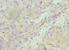 Immunohistochemistry of paraffin-embedded human colon cancer using CSB-PA022933ESR1HU at dilution of 1:100
