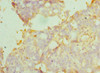 Immunohistochemistry of paraffin-embedded human endometrial cancer using CSB-PA002118ESR1HU at dilution of 1:100