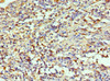 Immunohistochemistry of paraffin-embedded human cervical cancer using CSB-PA618638DSR1HU at dilution of 1:100