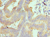 Immunohistochemistry of paraffin-embedded human colon cancer using CSB-PA618638DSR1HU at dilution of 1:100
