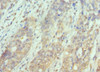 Immunohistochemistry of paraffin-embedded human endometrial cancer using CSB-PA613382DSR1HU at dilution of 1:100