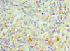 Immunohistochemistry of paraffin-embedded human melanoma using CSB-PA623788ESR1HU at dilution of 1:100