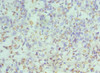 Immunohistochemistry of paraffin-embedded human endometrial cancer using CSB-PA618874DSR1HU at dilution of 1:100