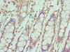 Immunohistochemistry of paraffin-embedded human colon cancer using CSB-PA011819ESR2HU at dilution of 1:100
