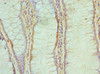 Immunohistochemistry of paraffin-embedded human colon cancer using CSB-PA614439ESR2HU at dilution of 1:100