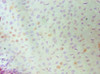 Immunohistochemistry of paraffin-embedded human cervical cancer using CSB-PA618894ESR2HU at dilution of 1:100