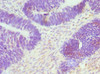 Immunohistochemistry of paraffin-embedded human ovarian cancer using CSB-PA006138DSR1HU at dilution of 1:100
