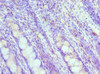 Immunohistochemistry of paraffin-embedded human colon cancer using CSB-PA619756ESR1HU at dilution of 1:100