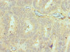 Immunohistochemistry of paraffin-embedded human colon cancer using CSB-PA850383ESR2HU at dilution of 1:100