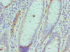 Immunohistochemistry of paraffin-embedded human colon cancer using CSB-PA843284ESR2HU at dilution of 1:100