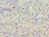 Immunohistochemistry of paraffin-embedded human liver cancer using CSB-PA897574ESR1HU at dilution of 1:100