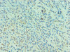 Immunohistochemistry of paraffin-embedded human breast cancer using CSB-PA618018ESR1HU at dilution of 1:100