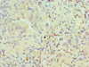 Immunohistochemistry of paraffin-embedded human lung cancer using CSB-PA017492DSR1HU at dilution of 1:100