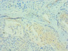 Immunohistochemistry of paraffin-embedded human breast cancer using CSB-PA703610DSR2HU at dilution of 1:100