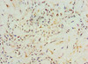 Immunohistochemistry of paraffin-embedded human breast cancer using CSB-PA001458ESR2HU at dilution of 1:100