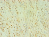 Immunohistochemistry of paraffin-embedded human breast cancer using CSB-PA002714ESR2HU at dilution of 1:100