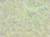 Immunohistochemistry of paraffin-embedded human liver cancer using CSB-PA003954ESR2HU at dilution of 1:100