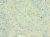 Immunohistochemistry of paraffin-embedded human liver cancer using CSB-PA003954ESR1HU at dilution of 1:100