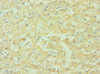 Immunohistochemistry of paraffin-embedded human liver cancer using CSB-PA004929ESR1HU at dilution of 1:100