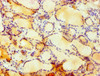 Immunohistochemistry of paraffin-embedded human thyroid tissue using CSB-PA615708ESR1HU at dilution of 1:100