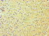 Immunohistochemistry of paraffin-embedded human liver cancer using CSB-PA006621DSR2HU at dilution of 1:100
