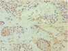 Immunohistochemistry of paraffin-embedded human breast cancer using CSB-PA007347ESR2HU at dilution of 1:100