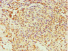 Immunohistochemistry of paraffin-embedded human breast cancer using CSB-PA007834DSR2HU at dilution of 1:100