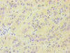 Immunohistochemistry of paraffin-embedded human liver cancer using CSB-PA008597ESR1HU at dilution of 1:100