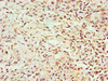 Immunohistochemistry of paraffin-embedded human breast cancer using CSB-PA009362ESR2HU at dilution of 1:100