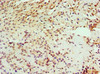 Immunohistochemistry of paraffin-embedded human breast cancer using CSB-PA878844ESR1HU at dilution of 1:100